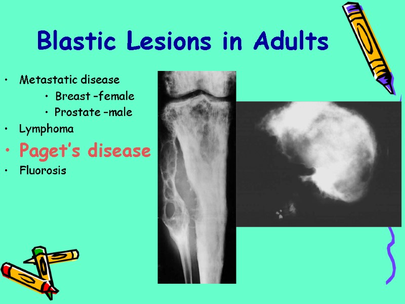 Metastatic disease Breast –female Prostate –male Lymphoma Paget’s disease Fluorosis Blastic Lesions in Adults